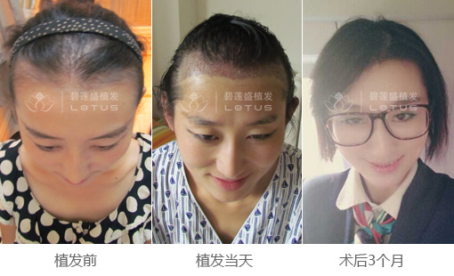 发际线植发效果