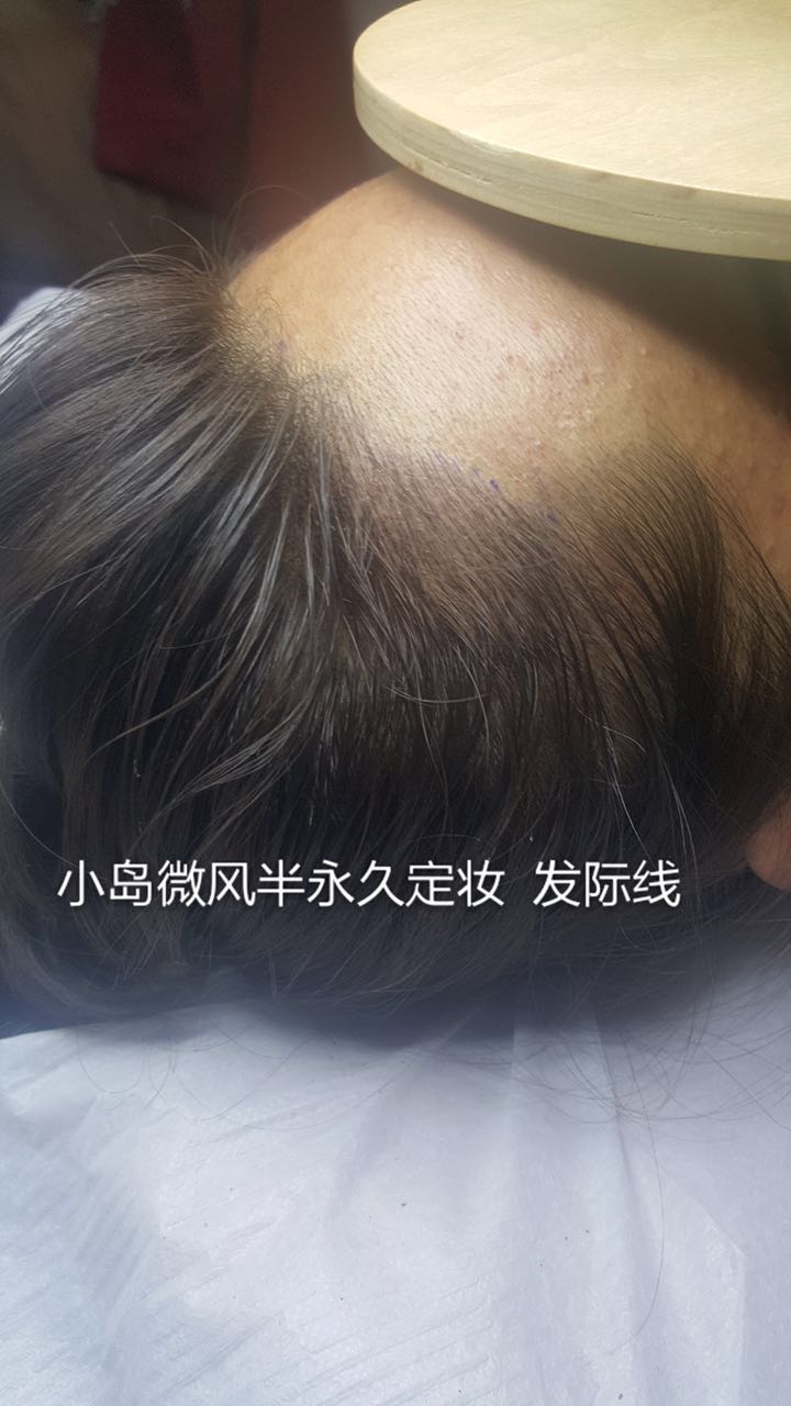 鹤壁发际线