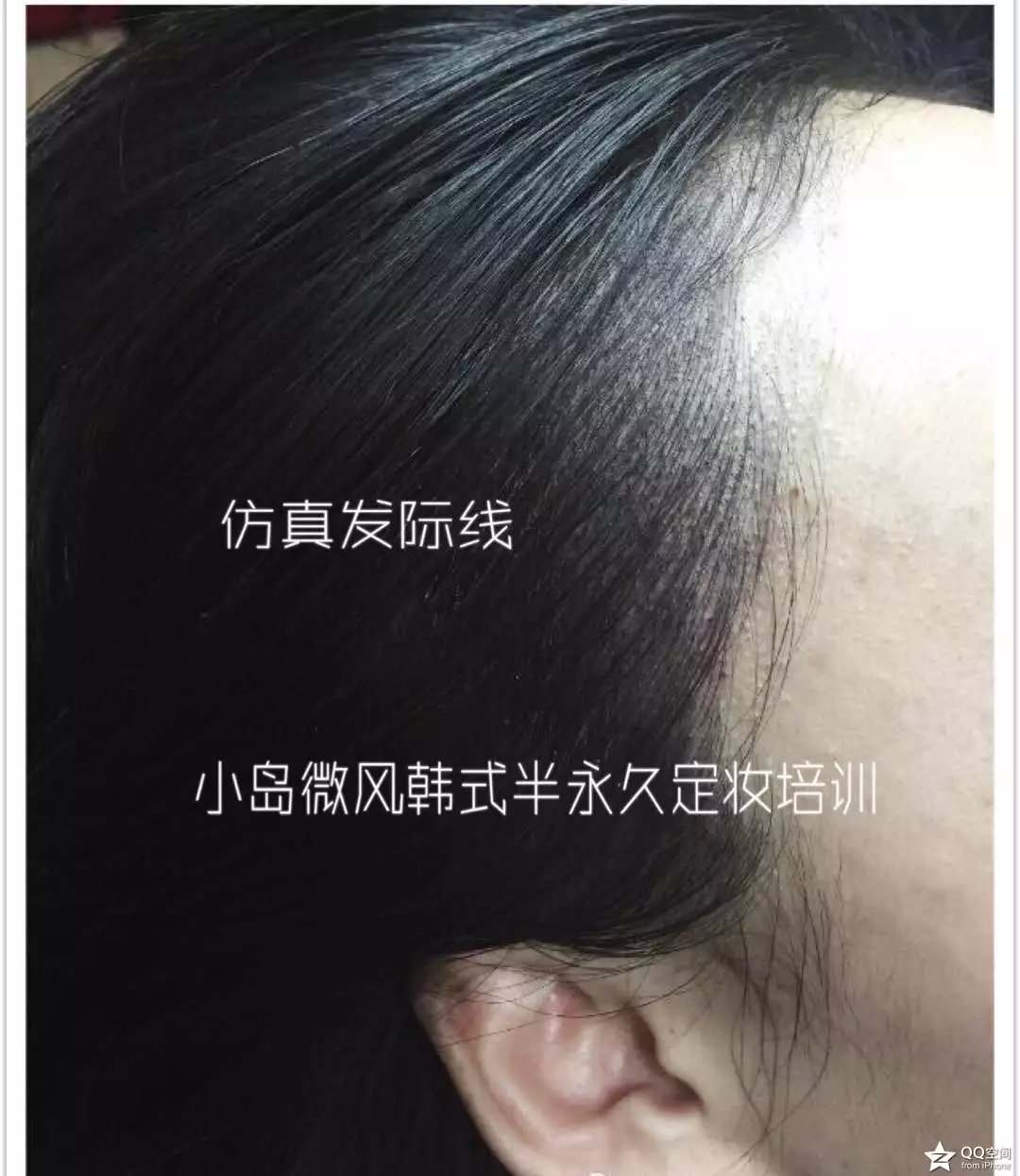 鹤壁发际线