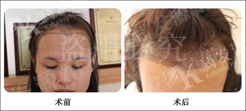 发际线调整怎么做得更加好看