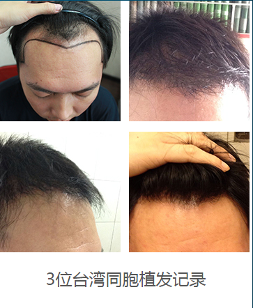 植发案例图