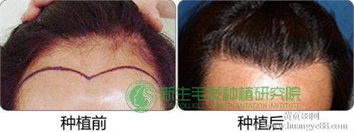 发际线不标准,该如何调整?