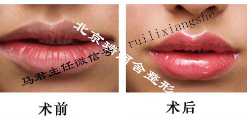 让嘴唇“嘭”起来的神奇丰唇术
