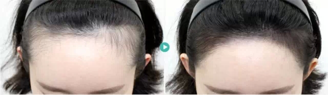 半永久发际线