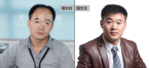 重庆发际线调整根据三庭五眼原则设计