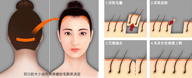 发际线种植示意图