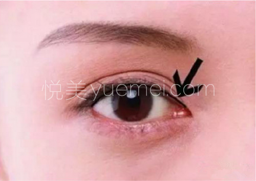 为什么要做完美瞳线有哪些注意事项