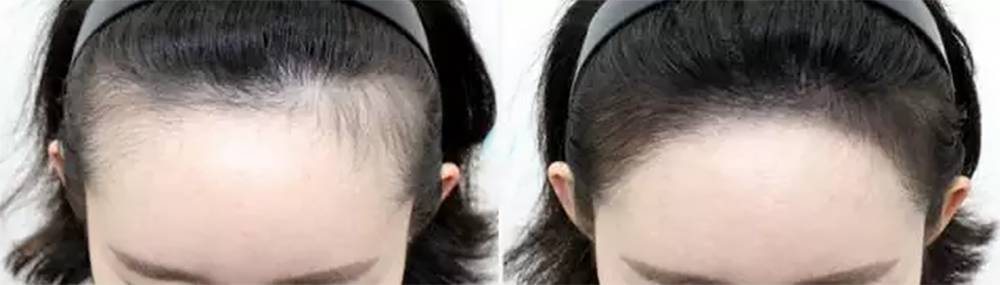 韩国纹发际线对比案例图